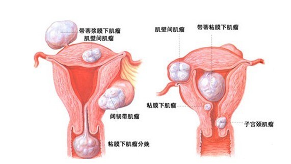 子宫肌瘤有什么症状
