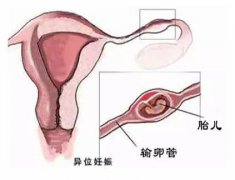 【宫外孕B超介入治疗方案】 保全输卵管，不损伤生育能力