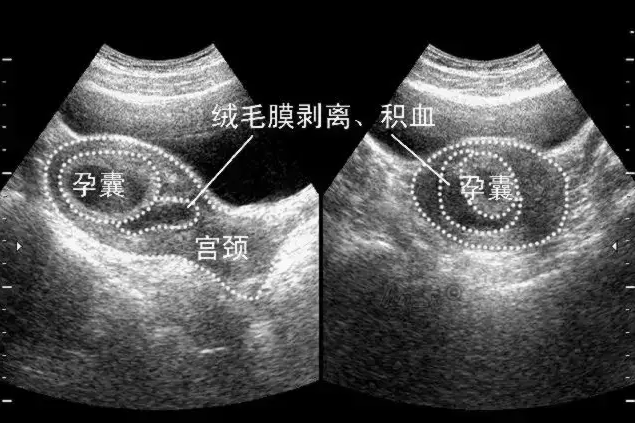 先兆流產絨毛膜下血腫聲像 西安安琪兒